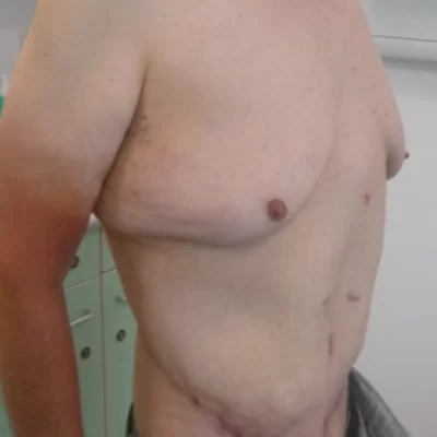 PATIENT DD - 45 to 54 yr M BODY LIFT AFTER