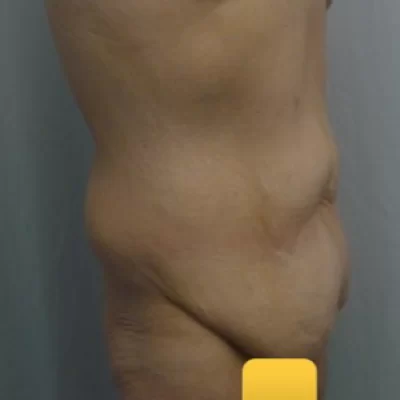 PATIENT DD - 45 to 54 yr M BODY LIFT BEFORE
