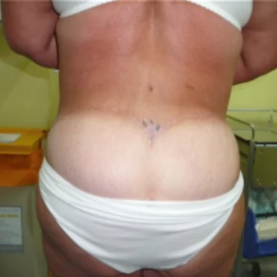 PATIENT EEE - 55 to 64 yr W BODY LIFT AFTER (2)