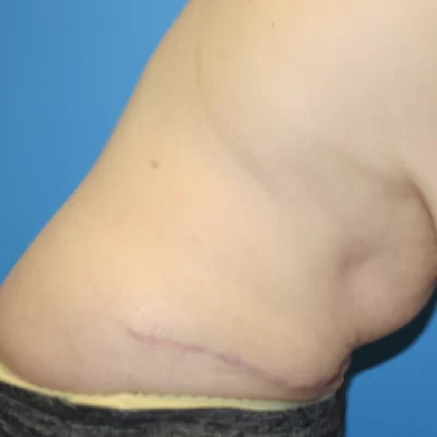 PATIENT KKK - 55 to 64 yr W TUMMY TUCK AFTER (2)