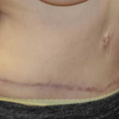 PATIENT KKK - 55 to 64 yr W TUMMY TUCK AFTER (2)