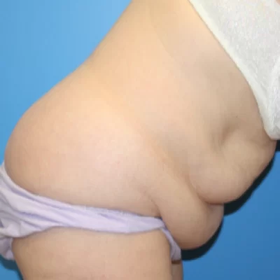 PATIENT KKK - 55 to 64 yr W TUMMY TUCK BEFORE (1)