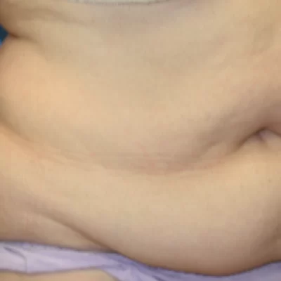 PATIENT KKK - 55 to 64 yr W TUMMY TUCK BEFORE (1)