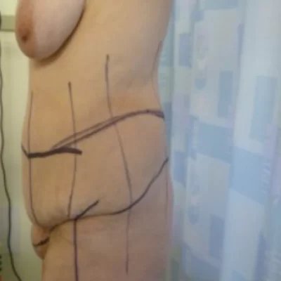 PATIENT LLL - 55 to 64 yr W THIGH LIFT BEFORE(1)