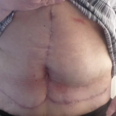 PATIENT MMM - 55 to 64 yr W TUMMY TUCK AFTER (2)