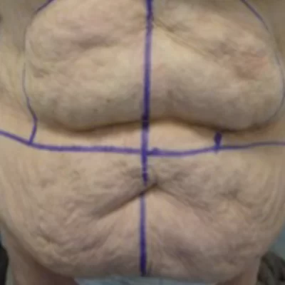 PATIENT MMM - 55 to 64 yr W TUMMY TUCK BEFORE (1)