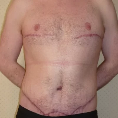 PATIENT O - 35 to 44 yr M BODY LIFT + GYNACOMASTIA AFTER