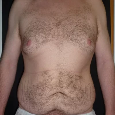 PATIENT O - 35 to 44 yr M BODY LIFT + GYNACOMASTIA BEFORE