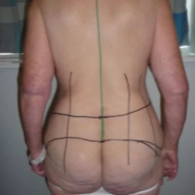 PATIENT PP - 45 to 54 yr W BODY LIFT BEFORE