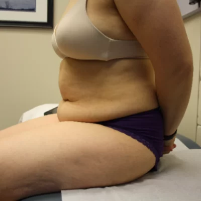 PATIENT VV - 45 to 54 yr W TUMMY TUCK BEFORE (1)