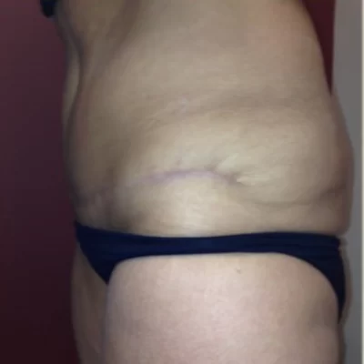 PATIENT WW - 45 to 54 yr W TUMMY TUCK AFTER (2) (1)