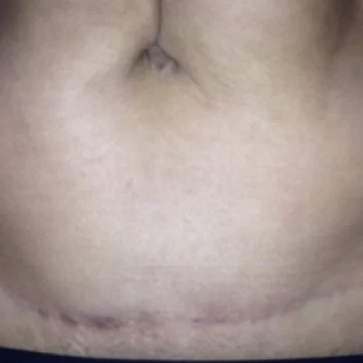 PATIENT WW - 45 to 54 yr W TUMMY TUCK AFTER (2)