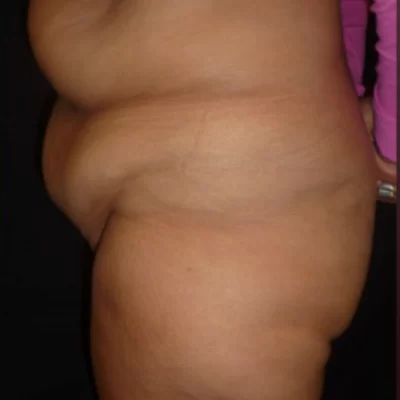 PATIENT WW - 45 to 54 yr W TUMMY TUCK BEFORE (1) (1)