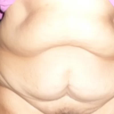 PATIENT WW - 45 to 54 yr W TUMMY TUCK BEFORE (1)