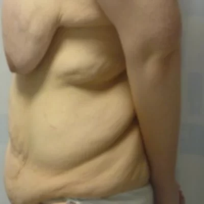 PATIENT X - 35 to 44 yr W Breast + Body L BEFORE (1)