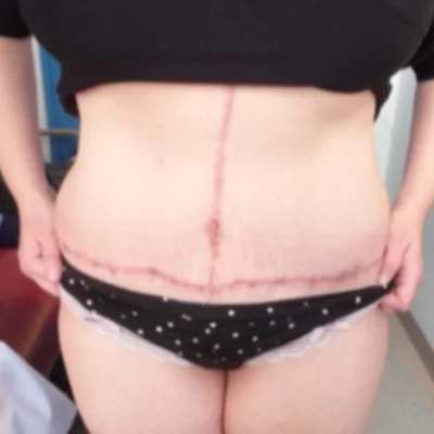 PATIENT XX - 45 to 54 yr W TUMMY TUCK AFTER (2)