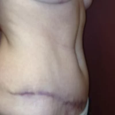 PATIENT YY - 45 to 54 yr W Tummy tuck AFTER (2)