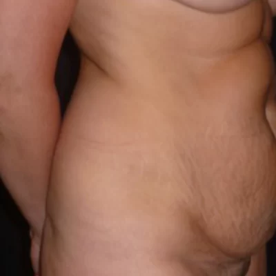 PATIENT YY - 45 to 54 yr W Tummy tuck BEFORE (1)